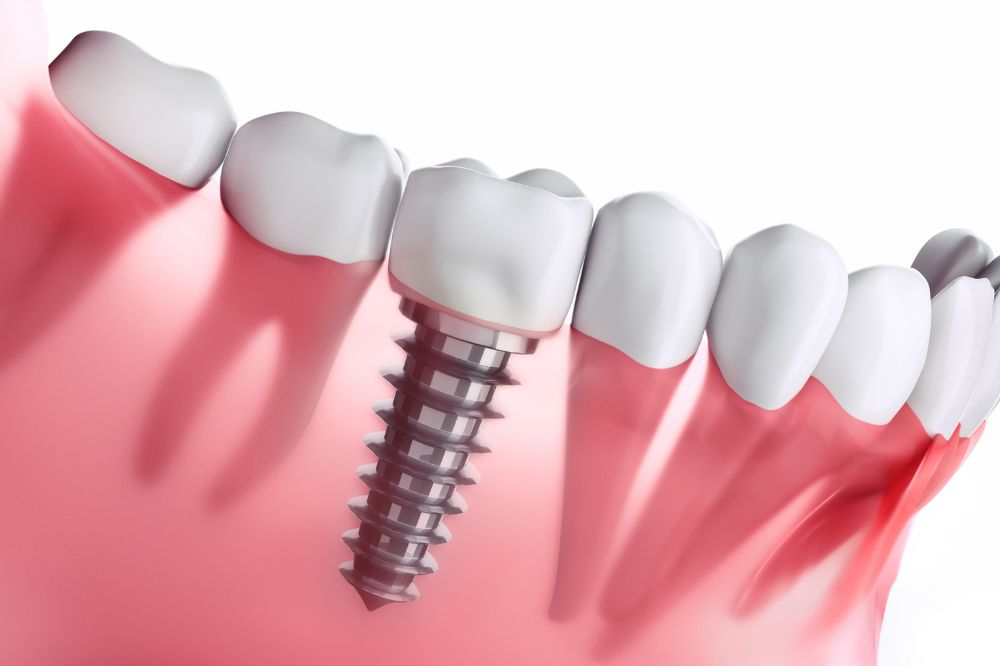 dental implants in Houston, TX