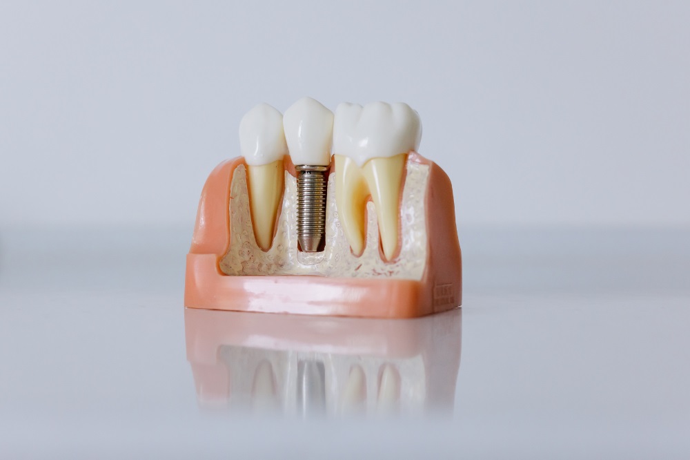 dental implant consultation in Spring, TX