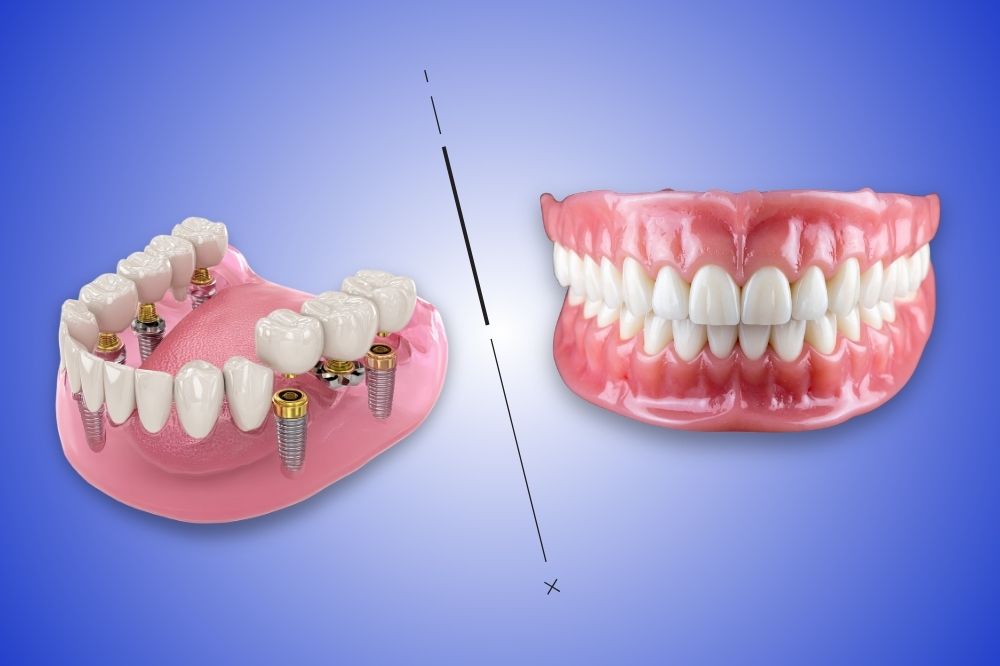 dental implants and dentures in Houston, TX
