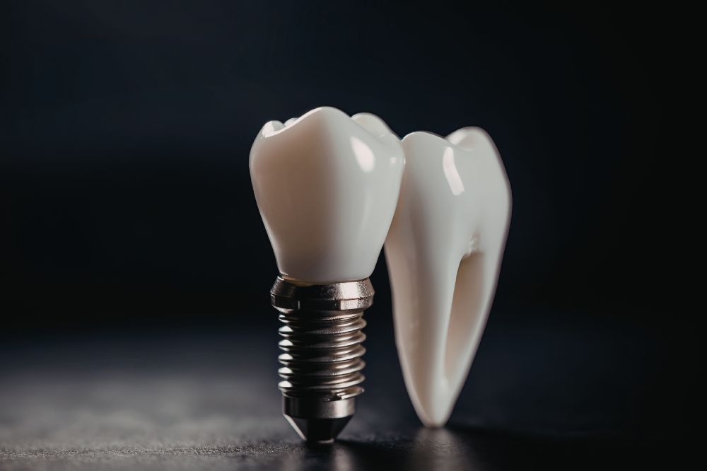 dental implant in Katy, Houston, TX