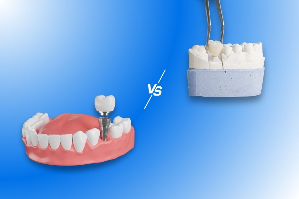 dental bridges in Houston, TX