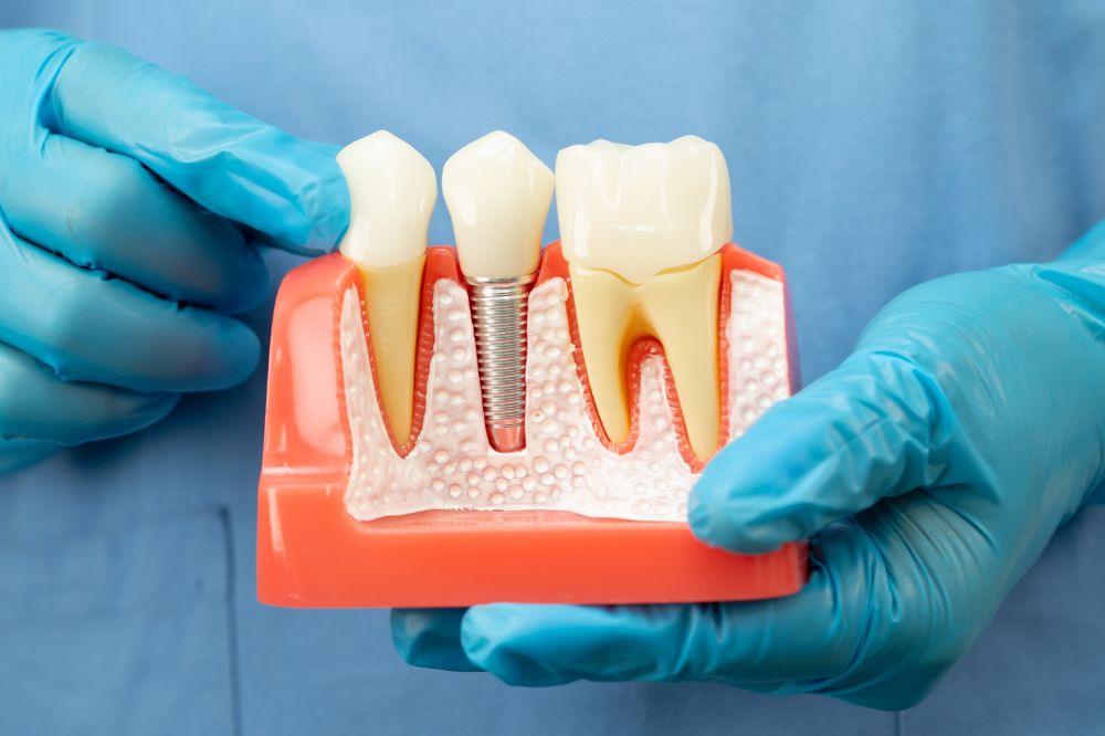 Dental Implants