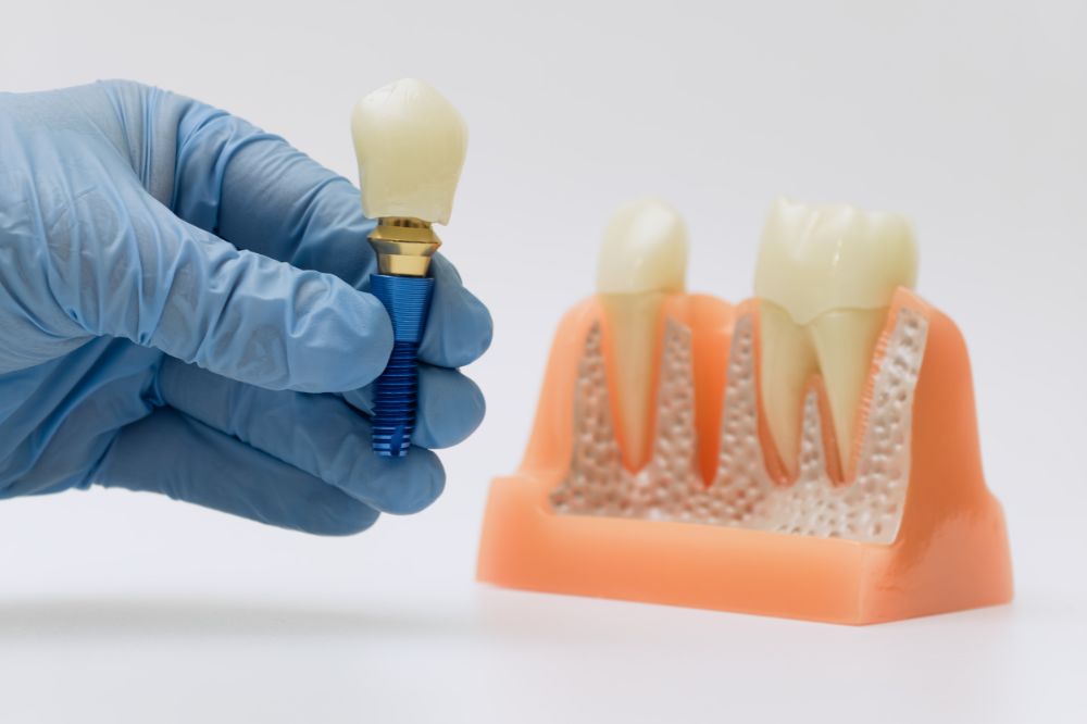 dental implants spring tx