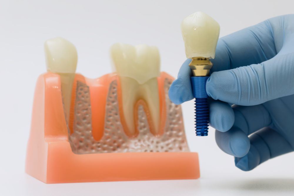 dental implants consultation in Spring, TX